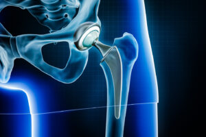 Hip Replacement in Shalimar Garden