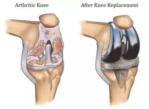 Knee Replacement in Shalimar Garden