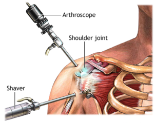 Shoulder Arthroscopy in Shalimar Garden