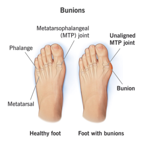 Bunions in Shalimar Garden