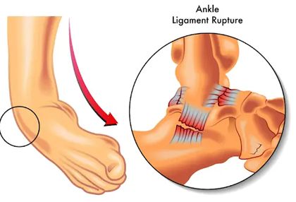 Torn Ligament in ShalimarGarden