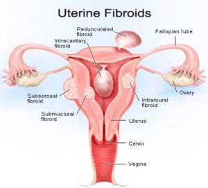 Fibroid Uterus