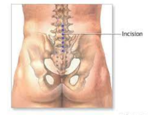 Lumbar spine surgery