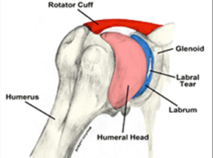 Torn labrum