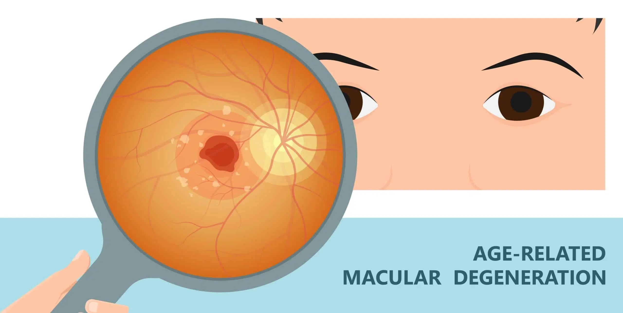 Age-Related Macular Degeneration (AMD) Early Signs to Know